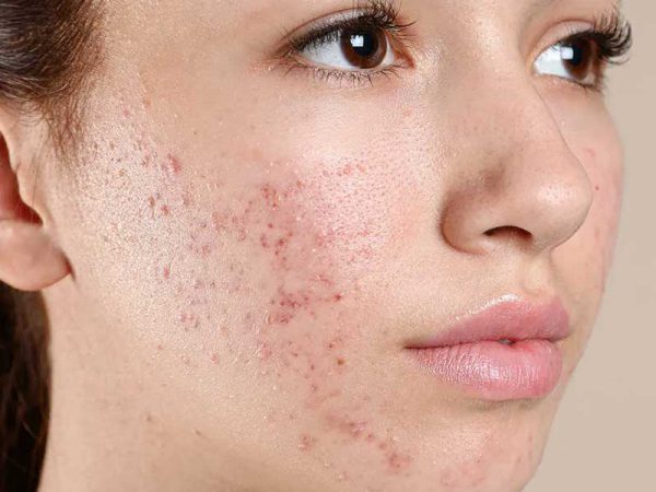 Acne Treatment in Punjabi Bagh