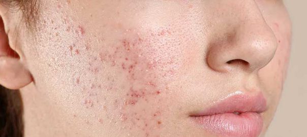 Acne Treatment in Punjabi Bagh