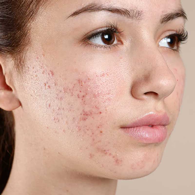 Acne Treatment in Punjabi Bagh