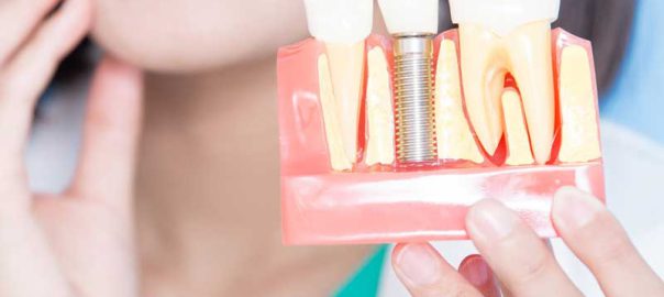 Multiple Tooth Implants in Punjabi Bagh