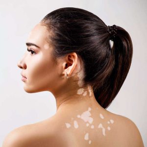 Vitiligo Treatment in Delhi