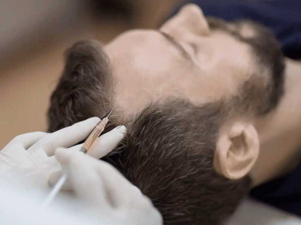 hair transplant in Punjabi Bagh