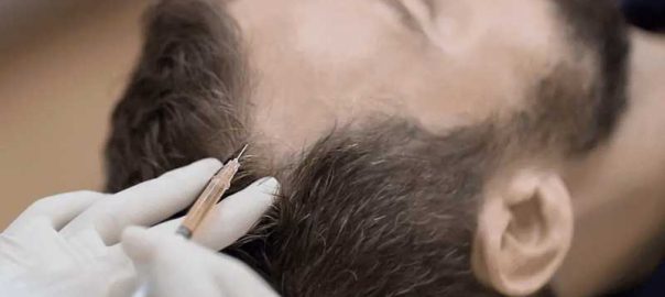 hair transplant in Punjabi Bagh