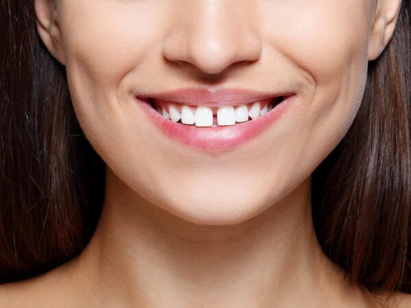 Treatment for Gaps in Teeth in Punjabi Bagh, Delhi