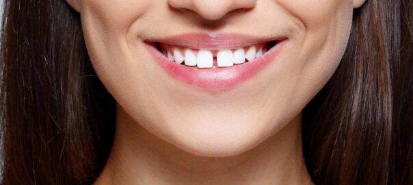 Treatment for Gaps in Teeth in Punjabi Bagh, Delhi